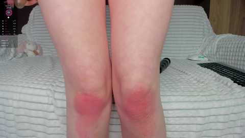 Media: Video of a fair-skinned person's knees, showing red, irritated skin with visible skin texture. Background features a white striped bedspread, a plush toy, and a black laptop.