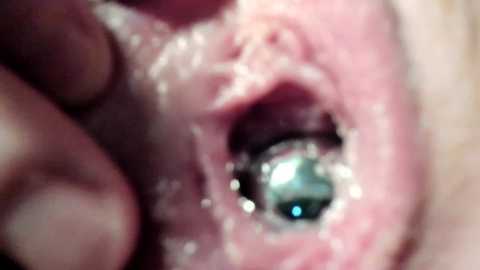 Media: Close-up video of a human eye, showing a metallic lens implant with a blue reflection, surrounded by pink, moist, and slightly inflamed tissue.